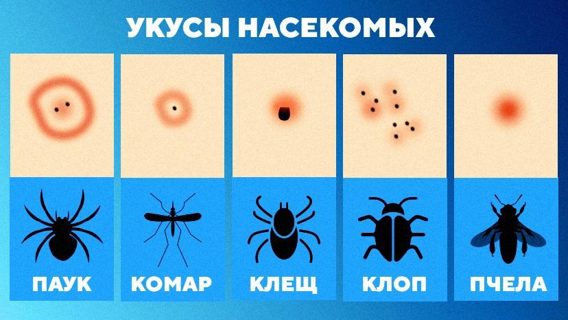 Аллергия на укусы насекомых: что делать?